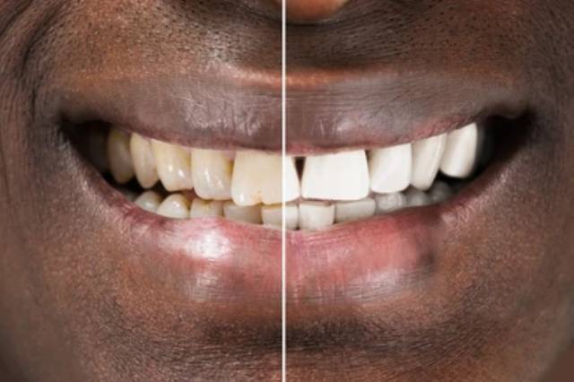 Whitening & Polishing